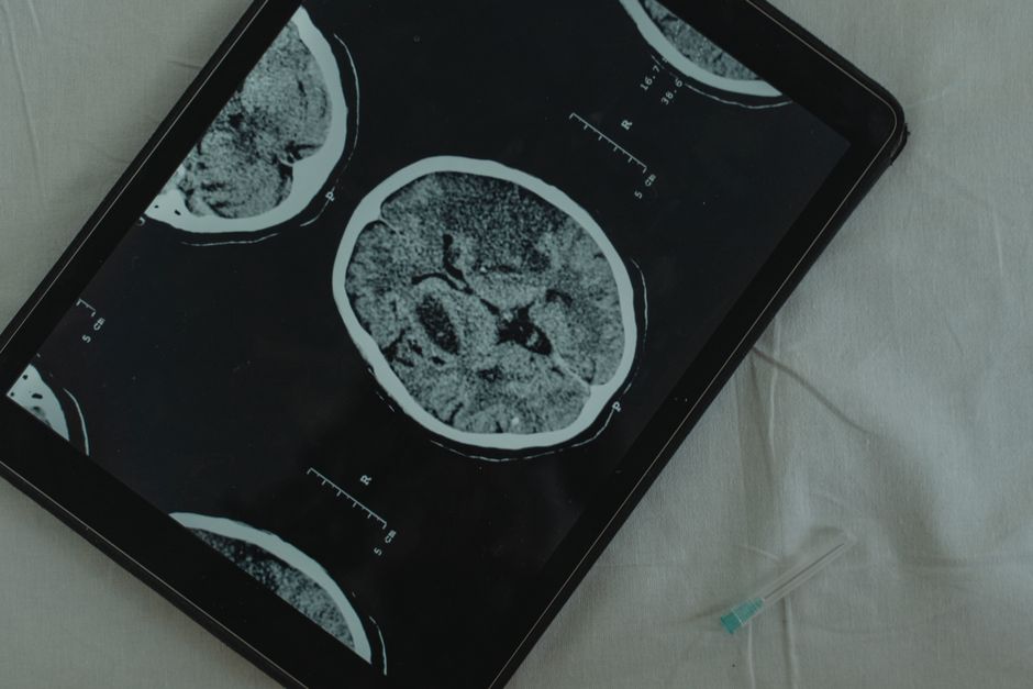 artificial intelligence in neurology — Will AI Revolutionize Neurology or Overstep Boundaries? (photo)