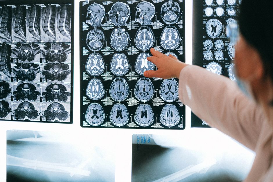 artificial intelligence in neurology — Will AI Revolutionize Neurology or Overstep Boundaries? (photo)